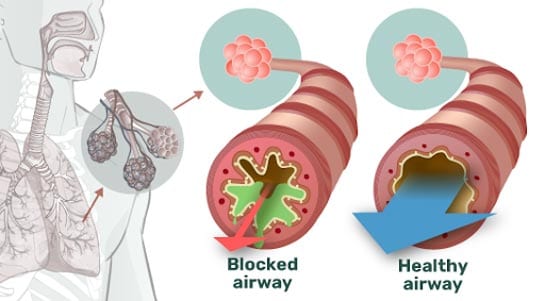 LungMaster Help You With