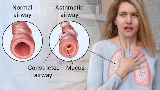 Can Asthma Be Cured By Yoga?