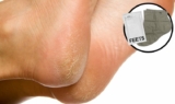 Foot Peel Mask by FEETS Review
